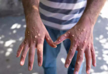 Mpox hits Cape Town, another person tests positive… 3 people have already died in South Africa