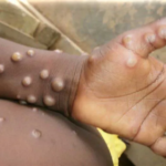 South Africa Confirms 22 Mpox Infections— Contact Tracing Begins as Cape Town Man’s Mpox Test Turns Positive After Trip to Spain