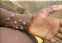 South Africa Confirms 22 Mpox Infections— Contact Tracing Begins as Cape Town Man’s Mpox Test Turns Positive After Trip to Spain