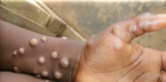 South Africa Confirms 22 Mpox Infections— Contact Tracing Begins as Cape Town Man’s Mpox Test Turns Positive After Trip to Spain