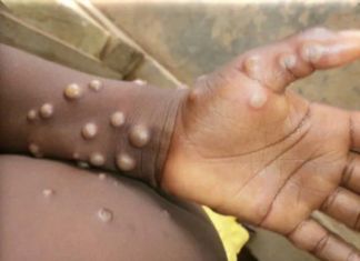 South Africa Confirms 22 Mpox Infections— Contact Tracing Begins as Cape Town Man’s Mpox Test Turns Positive After Trip to Spain