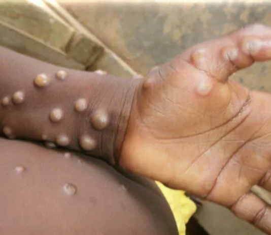 South Africa Confirms 22 Mpox Infections— Contact Tracing Begins as Cape Town Man’s Mpox Test Turns Positive After Trip to Spain