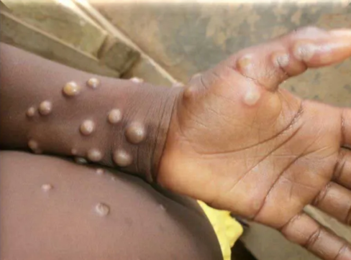 Mpox