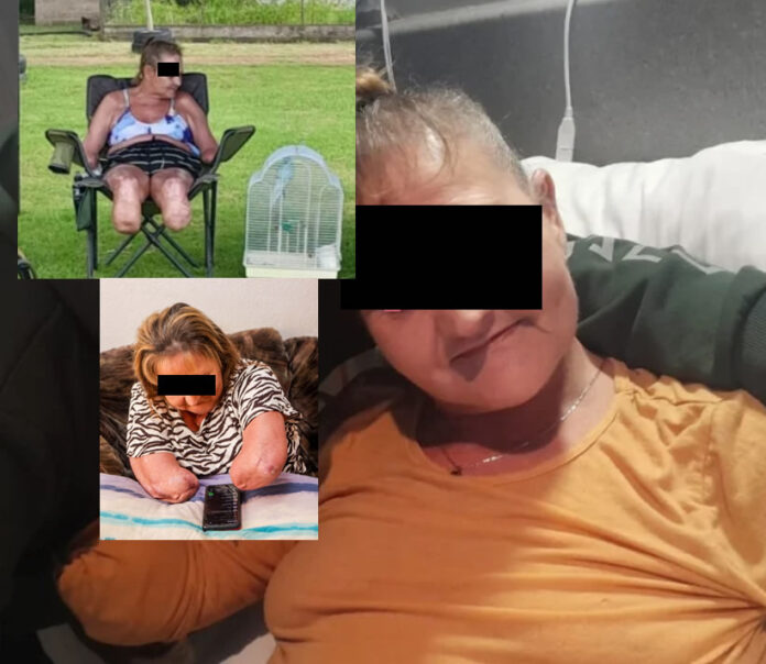 loadshed amputee